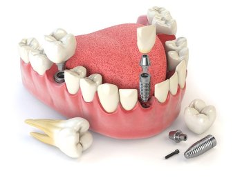 Te tudod, hogy mi az a fogászati implantátum?
